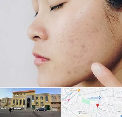 دکتر جوش صورت در زنبیل آباد قم