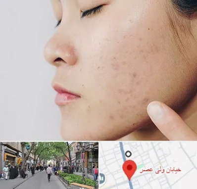 دکتر جوش صورت در ولیعصر شهریار