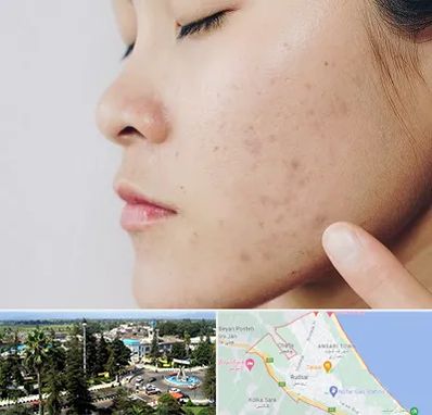 دکتر جوش صورت در رودسر