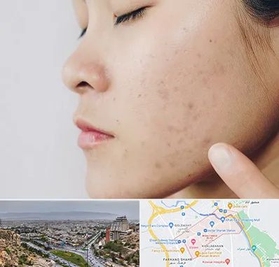 دکتر جوش صورت در معالی آباد شیراز