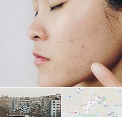 دکتر جوش صورت در محمد شهر کرج