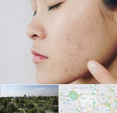 دکتر جوش صورت در منطقه 16 تهران