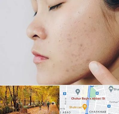 دکتر جوش صورت در چهارباغ اصفهان