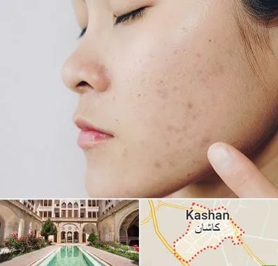 دکتر جوش صورت در کاشان