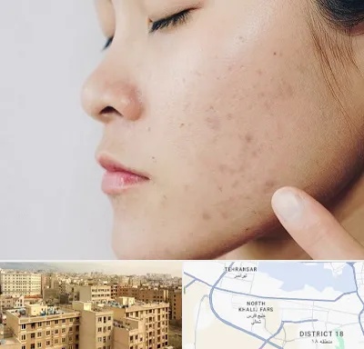 دکتر جوش صورت در جنوب غرب تهران