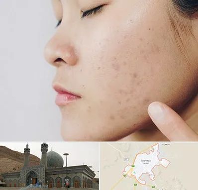 دکتر جوش صورت در شهرضا