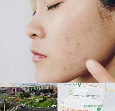 دکتر جوش صورت در تهرانسر 