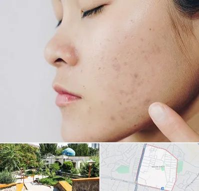 دکتر جوش صورت در باغمیشه تبریز