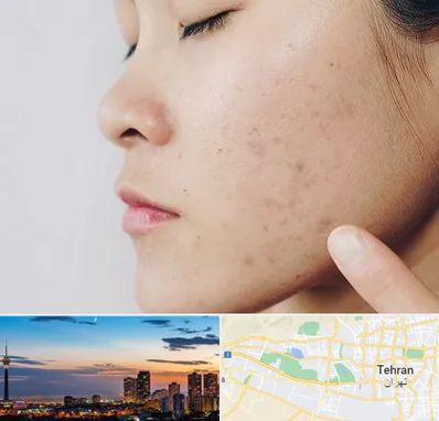 دکتر جوش صورت در غرب تهران 