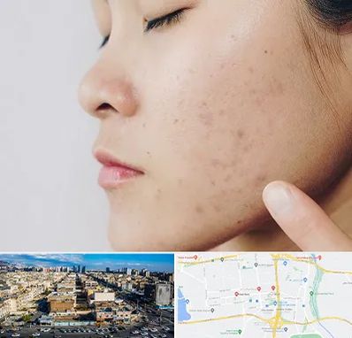 دکتر جوش صورت در شهرک راه آهن