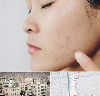 دکتر جوش صورت در اسکندری