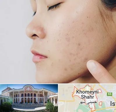 دکتر جوش صورت در خمینی شهر