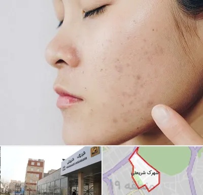 دکتر جوش صورت در شهرک شریعتی