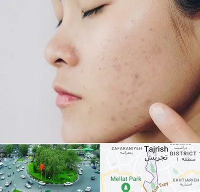 دکتر جوش صورت در تجریش 