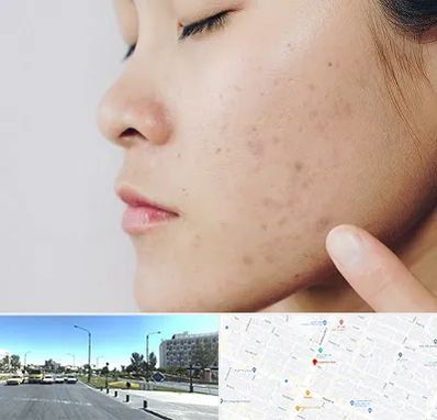 دکتر جوش صورت در بلوار کلاهدوز مشهد