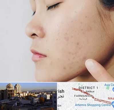 دکتر جوش صورت در فرمانیه 