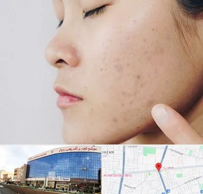 دکتر جوش صورت در نصف راه تبریز