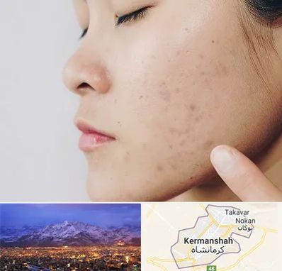 دکتر جوش صورت در کرمانشاه