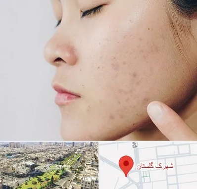 دکتر جوش صورت در شهرک گلستان