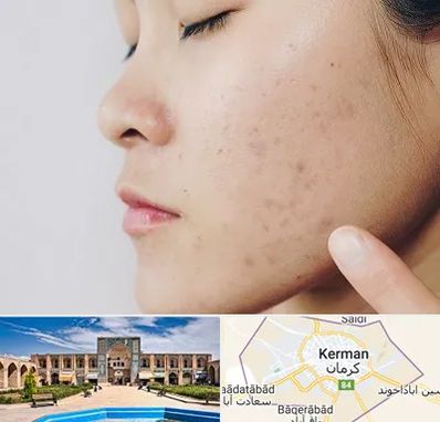دکتر جوش صورت در کرمان