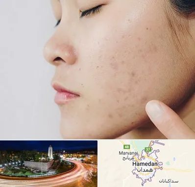 دکتر جوش صورت در همدان