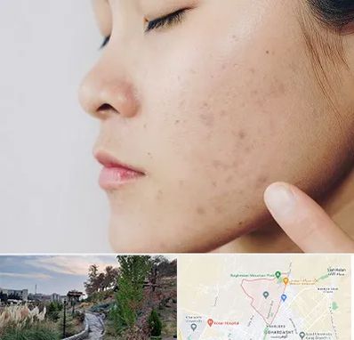 دکتر جوش صورت در باغستان کرج