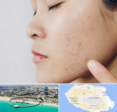 دکتر جوش صورت در کیش