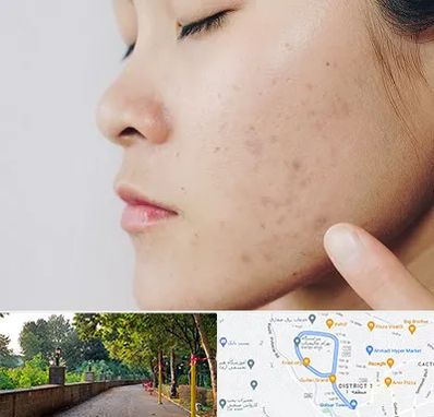 دکتر جوش صورت در فلکه گاز رشت