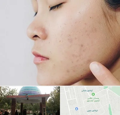 دکتر جوش صورت در کیانشهر