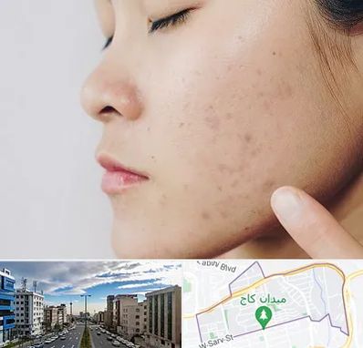 دکتر جوش صورت در سعادت آباد 