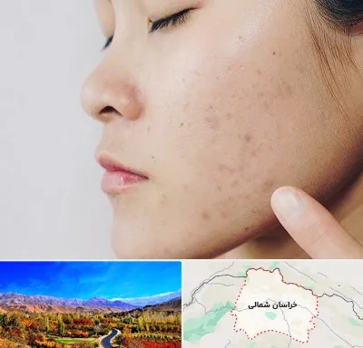 دکتر جوش صورت در خراسان شمالی