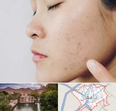 دکتر جوش صورت در دامغان