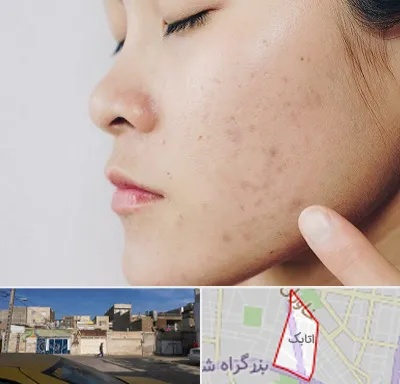 دکتر جوش صورت در اتابک