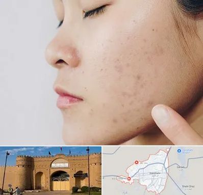 دکتر جوش صورت در ایرانشهر