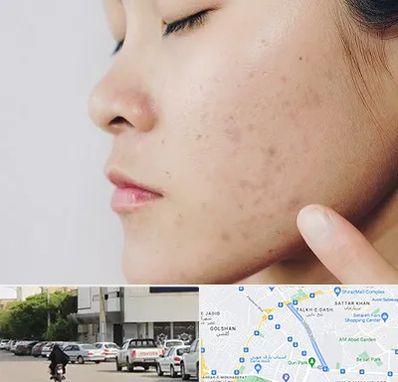 دکتر جوش صورت در قدوسی شرقی شیراز