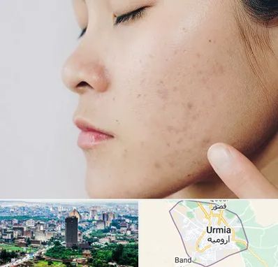 دکتر جوش صورت در ارومیه