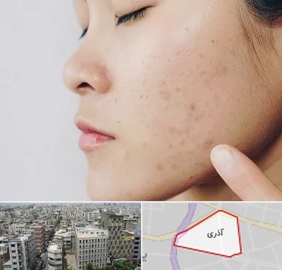 دکتر جوش صورت در آذری