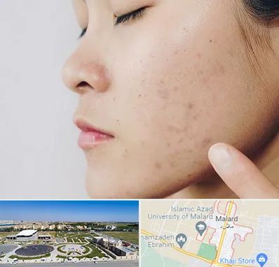 دکتر جوش صورت در ملارد