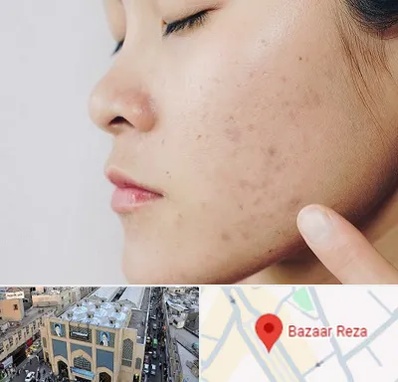 دکتر جوش صورت در بازار رضا مشهد