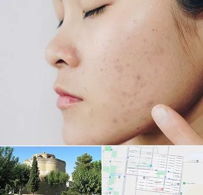 دکتر جوش صورت در مرداویج اصفهان