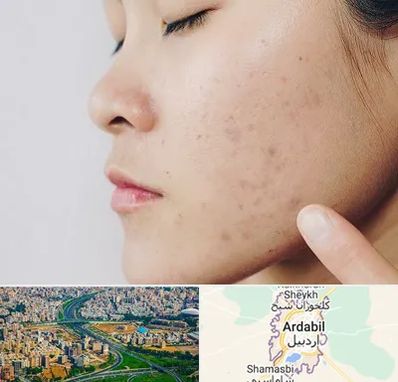 دکتر جوش صورت در اردبیل