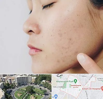 دکتر جوش صورت در جهانشهر کرج 