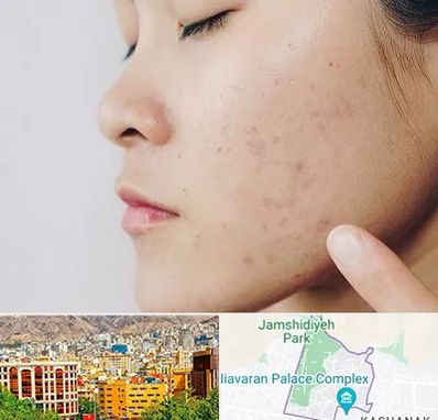 دکتر جوش صورت در نیاوران 