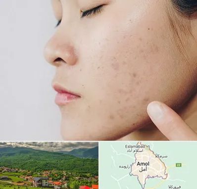 دکتر جوش صورت در آمل