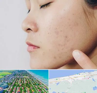 دکتر جوش صورت در فریدونکنار