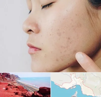 دکتر جوش صورت در هرمزگان
