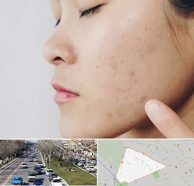 دکتر جوش صورت در احمدآباد مشهد