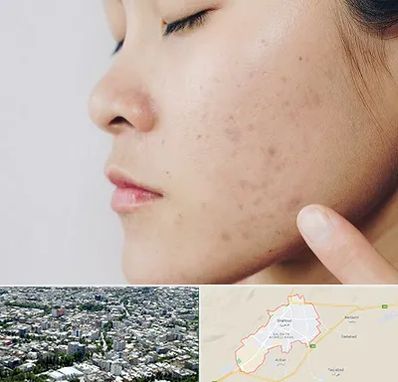 دکتر جوش صورت در شاهرود