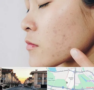 دکتر جوش صورت در کوهک