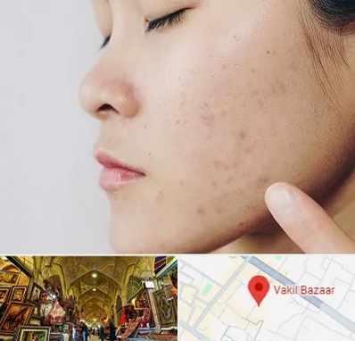 دکتر جوش صورت در بازار وکیل شیراز